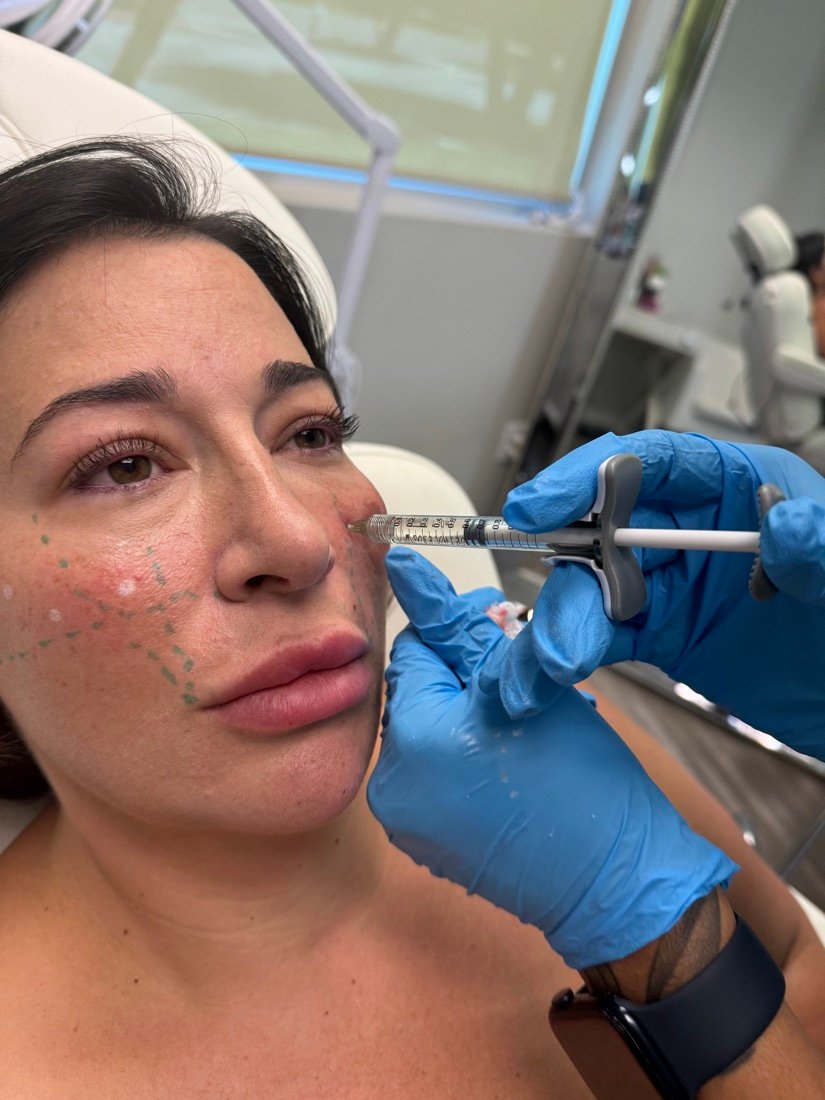 Dermal filler treatment at Soluxe