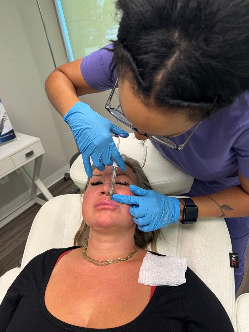 Lip filler treatment at Soluxe